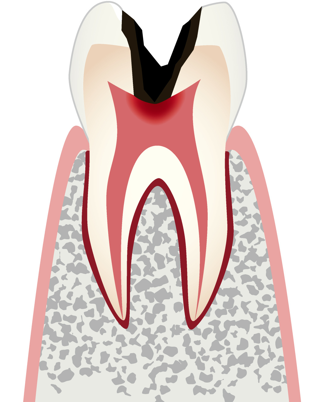 C3 歯髄に達した虫歯