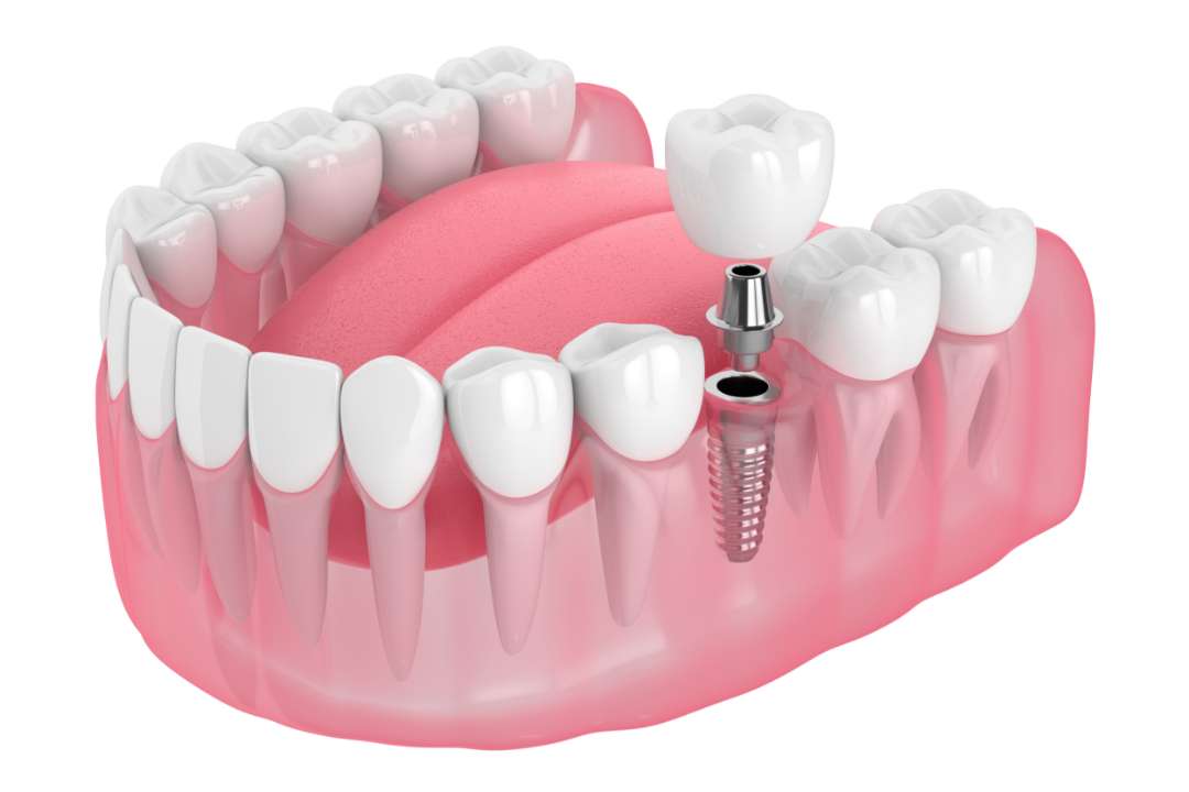 治療期間の短縮を図れる抜歯即時埋入による治療
