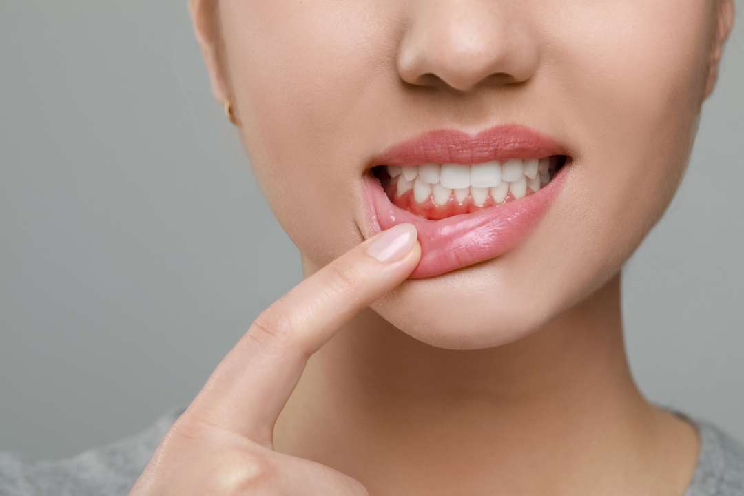 自然で美しい口元を作る審美歯周外科治療にも対応